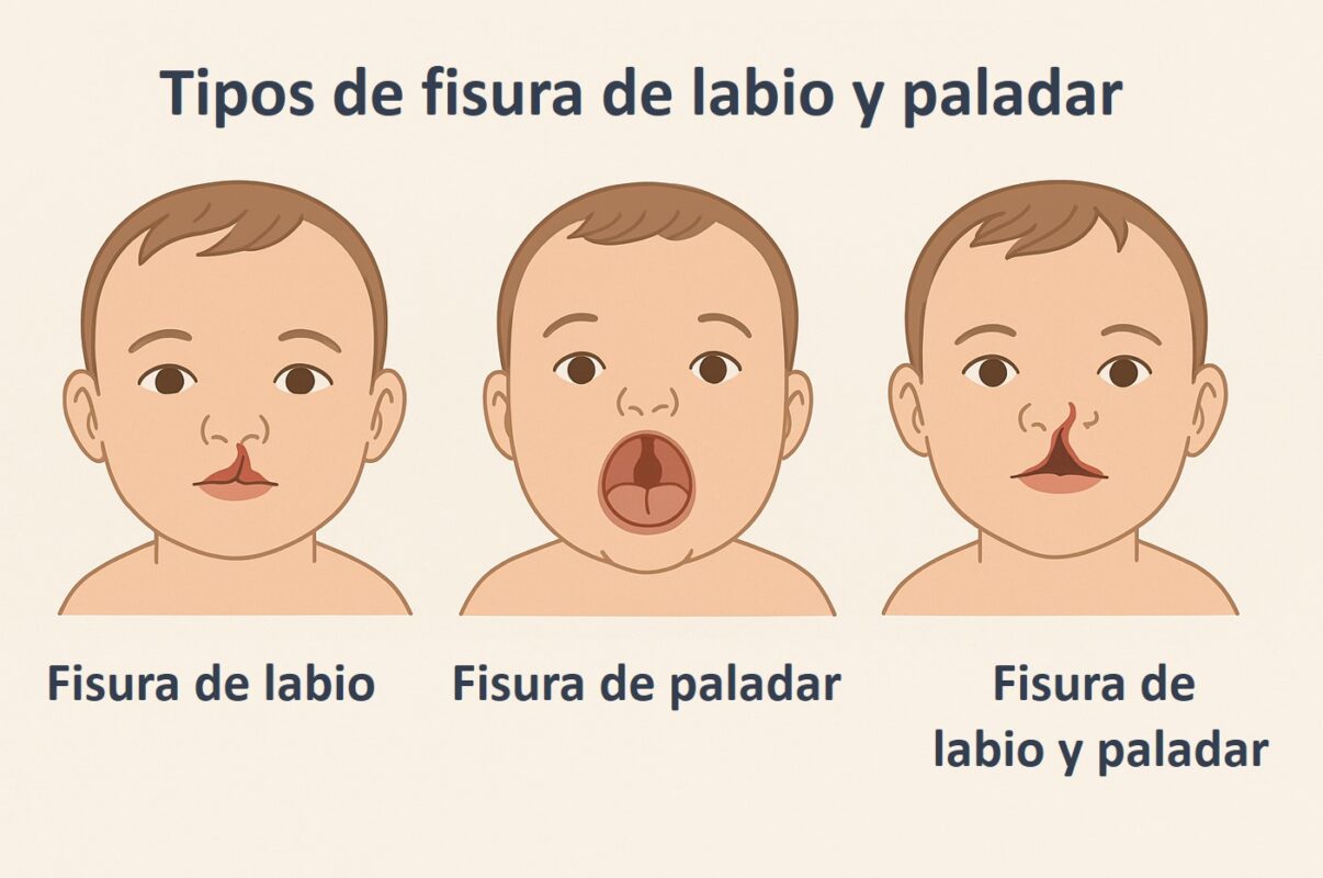 Ilustración médica que muestra los tipos de fisura: fisura de labio, fisura de paladar y fisura de labio y paladar