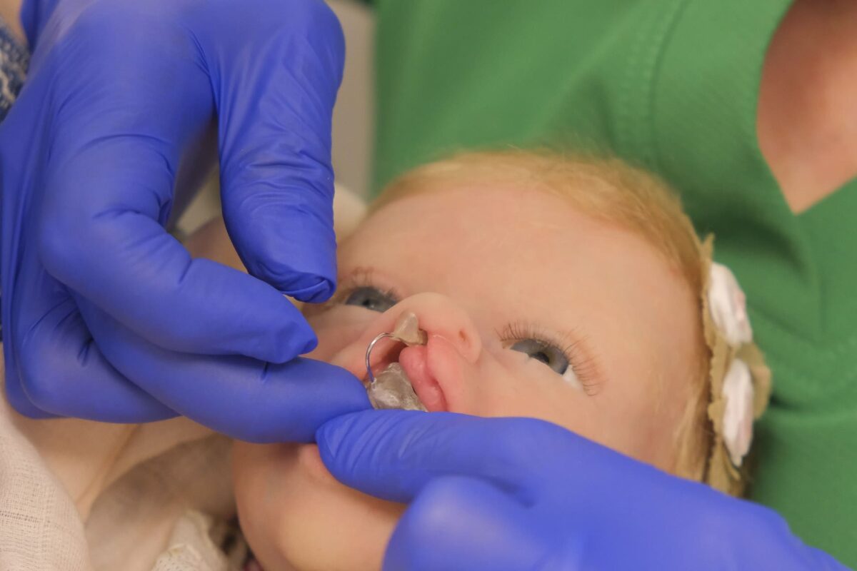 Demostración clínica del moldeado nasal prequirúrgico en un bebé con fisura labiopalatina