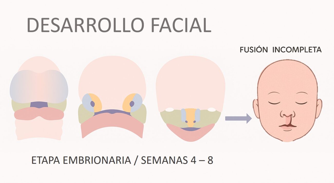 Ilustración del desarrollo facial en la etapa embrionaria entre las semanas 4 y 8, mostrando la fusión incompleta