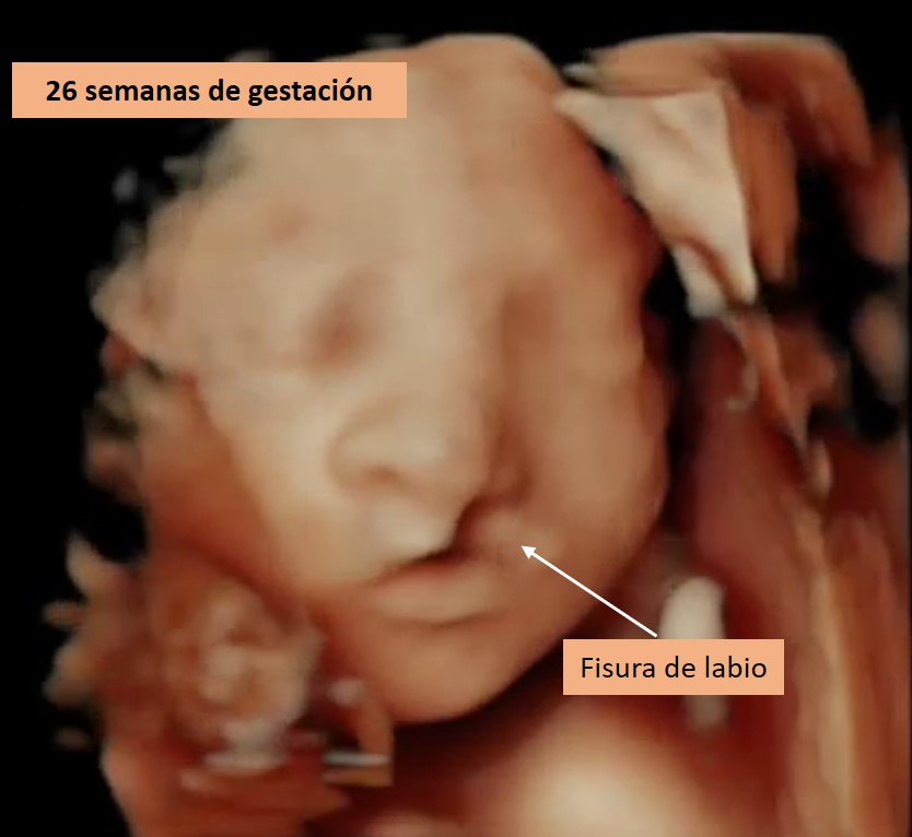 Ecografía 3D a las 26 semanas de gestación que muestra una fisura de labio, con acompañamiento emocional a la madre embarazada
